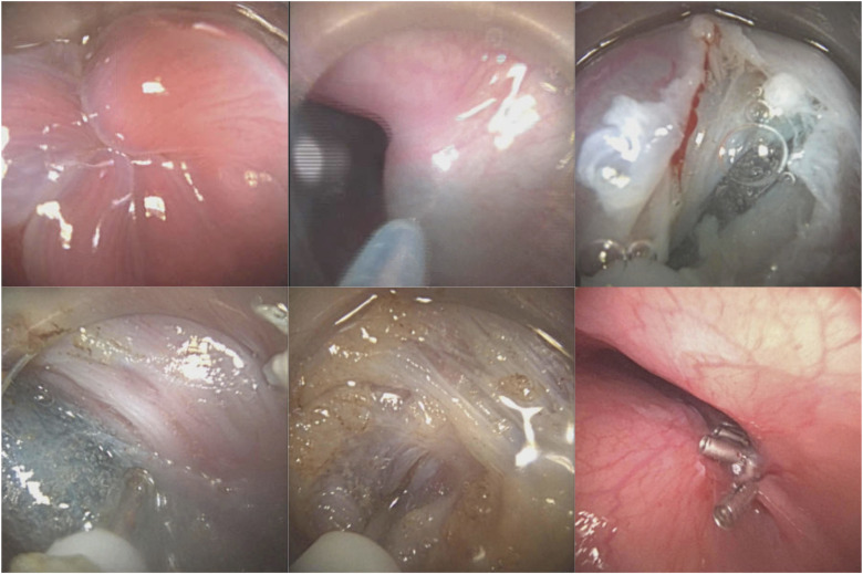 From this month's issue of VideoGIE: 'Feasibility of peroral endoscopic myotomy with a disposable endoscope platform' by Tara Keihanian et al. videogie.org/article/S2468-… @endoscopyothman @keihanianTara @KaraRaphael