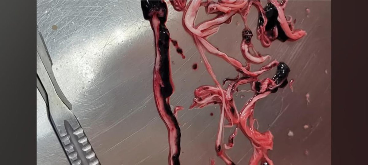 Sinds 2020 halen verschillende pathologen deze creaties naar eigen zeggen uit aderen van zo'n 20% van de overledenen. De witte draden blijken een samenklontering van eiwitten te zijn die de aderen volledig verstoppen. 

#NOS, iets voor jullie om uit te zoeken? 
Tekst: Jochem #fb
