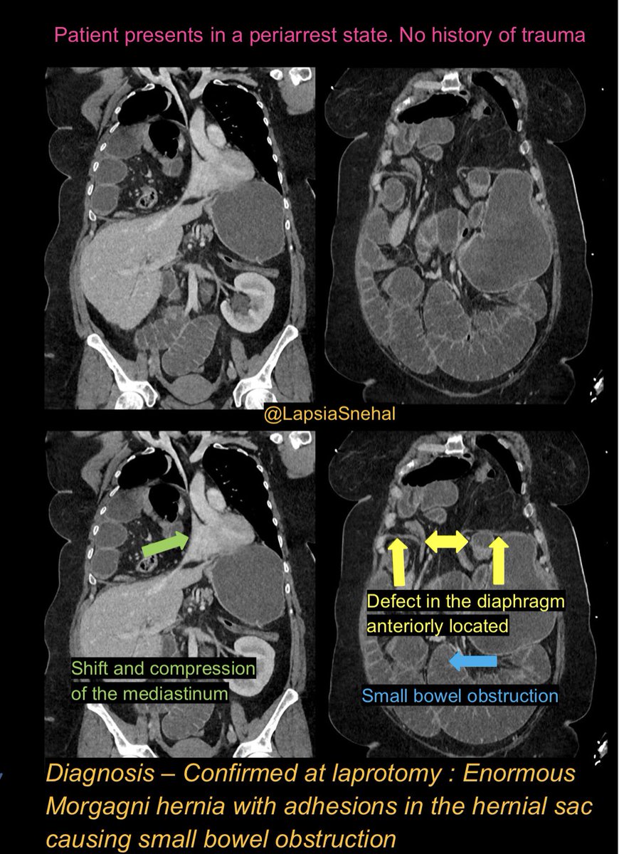 I can hear bowel sounds in the chest! No history of trauma. #FOAMrad #FOAMed #meded #radres #futureradres #medstudenttwitter #gitwitter #anatomy #frcr #surgery #radiology #radtwitter #medtwitter