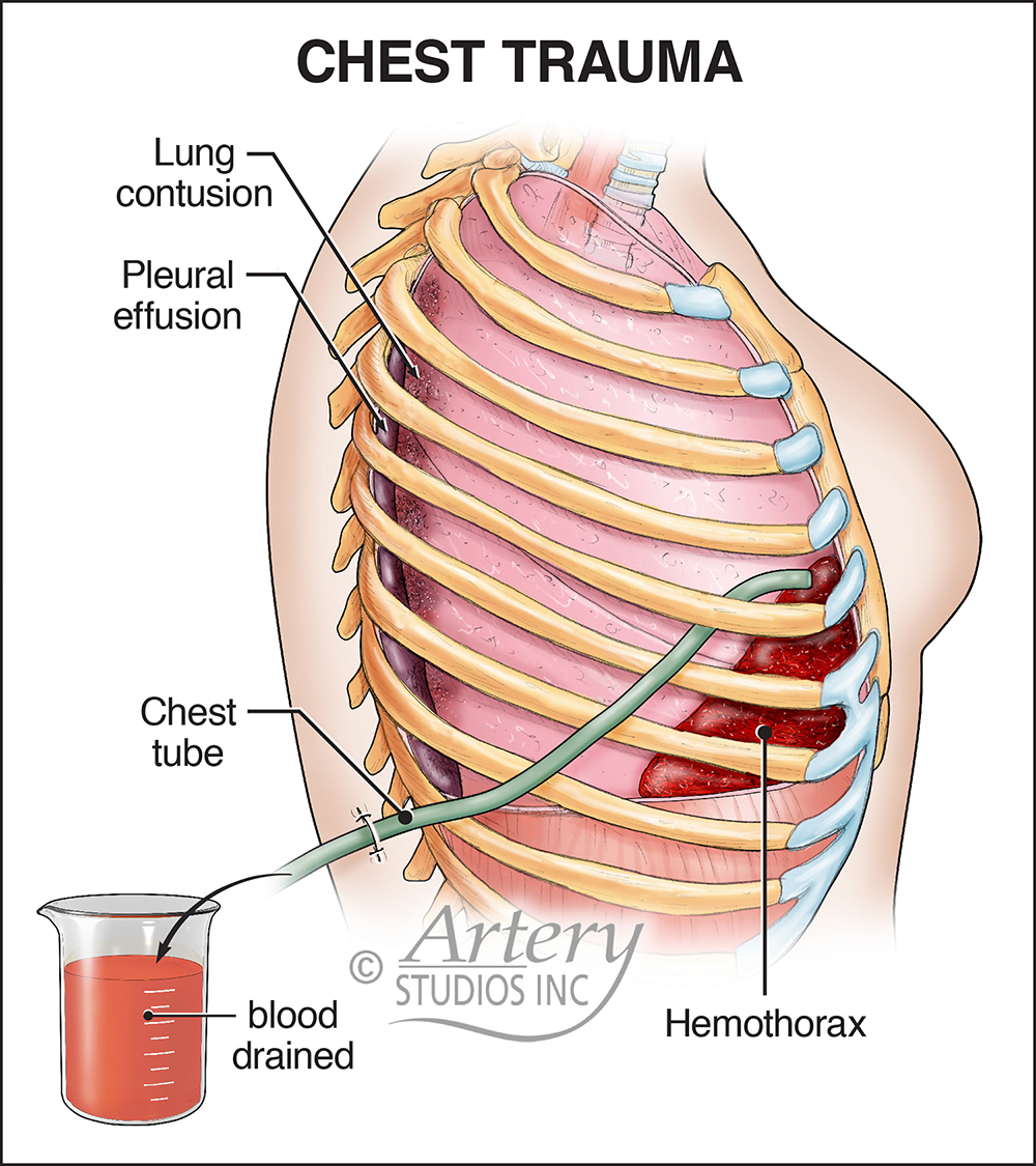 Having trouble catching your breath? It might not be love –
Hemothorax can occur from blunt chest trauma after a car crash, when the pleural cavity – potential space between lung and ribs – fills with blood after lung or rib injury. A tube thoracostomy can be life-saving.
#lawyer