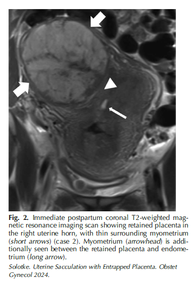 Three new articles now available ahead of print, including a case report on uterine sacculation with entrapped placenta after delivery. Go get your knowledge at ow.ly/S7o250QAHJr