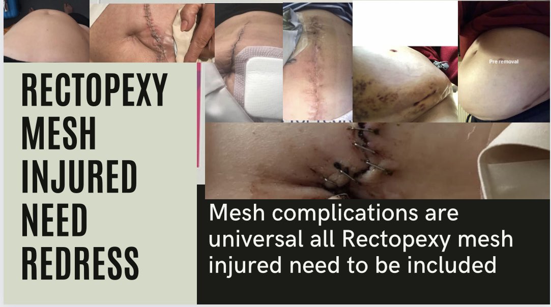 All patients with Rectopexy Mesh complications cannot be excluded, thousands affected since the Cumberlege review inclusion needed #redressforrectopexymeshinjured #redressnow @LukeHall @PSCommissioner @DHSCgovuk @AlecShelbrooke @mariacaulfield @Rebeccasmt @AnnaCollinson @SkyNews