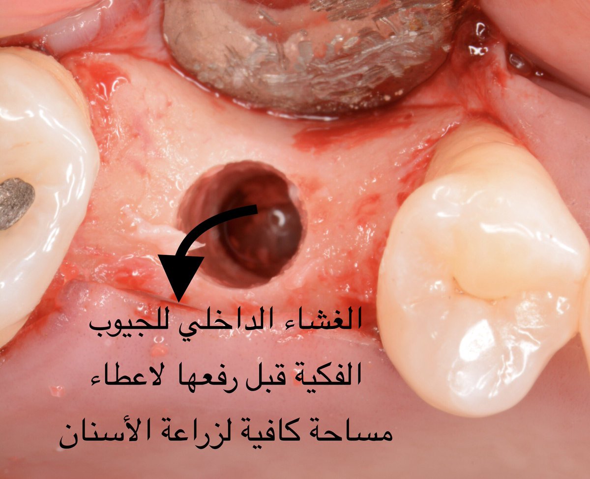 MustafaTash1's tweet photo. عملية رفع الجيوب الفكية من الداخل عملية بسيطة وروتينية تتم تحت التخدير الموضعي ولاتأخذ أكثر من ساعة تقريباً مع وضع الزرعات.👌🏻
غالباً يكون الألم بسيط جداً بعد هذا الاجراء ويتم وصف مسكنات بسيطة بعدها.

تتم في حالات فقدان الاسنان وعدم تعويضعها مباشرة مما يتسبب في  نزول الجيوب الفكية https://t.co/7vLYB2hn3A