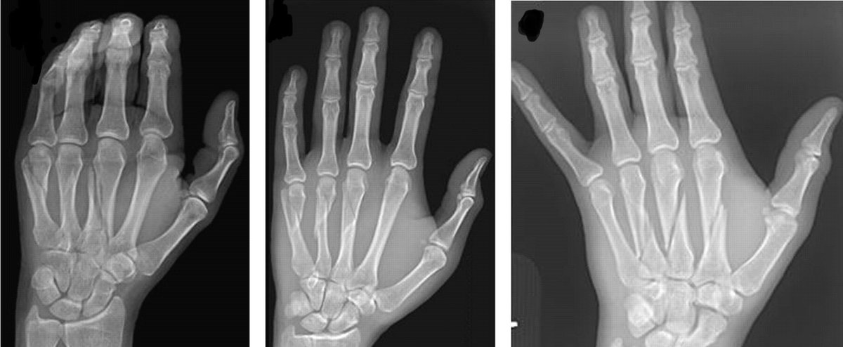 PhysioConnor's tweet photo. ✋🏼🧵 A thread all about common fractures patterns of the metacarpal bones 🧵🤚🏼

This thread will contain both radiological features and common mechanisms for the fractures.

#HandTherapy #Physiotherapy #OccupationalTherapy https://t.co/uB4VYQsm3q