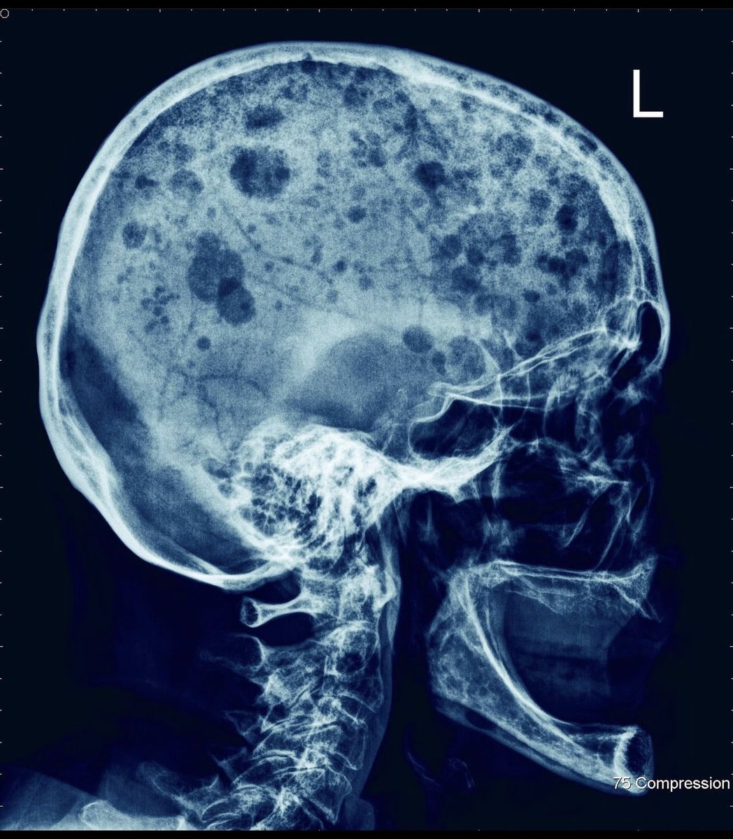 Oncology Quiz✨
•
PUNCHED OUT lytic lesions, along with anemia, hypercalcemia, and renal failure, are indicative of which hematological disorder?

A) Spherocytosis
B) Multiple Myeloma
C) G6PD
D) CML

#Hematology #MedicalTwitter #MCQ'