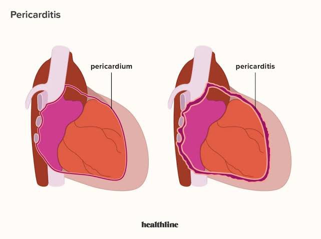 CardioMed✨🫀
•
Which viruses can cause #viral_pericarditis?

A) Coxsackieviruses
B) Adenoviruses
C) Sarscovviruses
D) Herpesviruses

#Pericarditis #ViralInfections #MedicalTwitter'