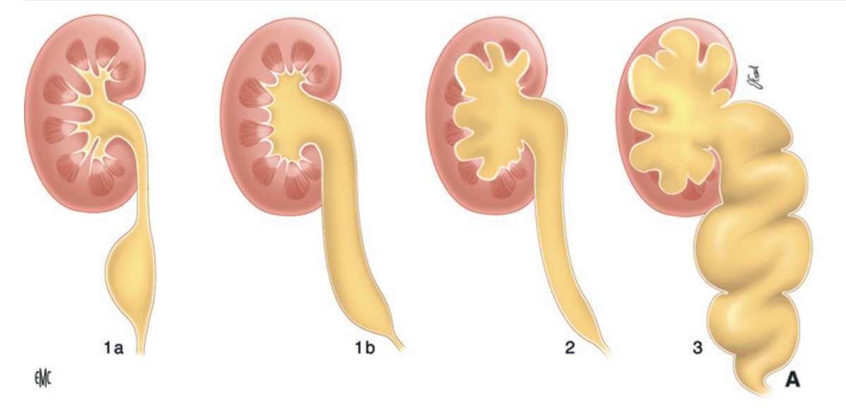 siupurol's tweet photo. El tratamiento del #MEGAURETER está enfocado a prevenir el daño renal y, como consecuencia, la pérdida irreversible de la función y empeoramiento en los hallazgos radiográficos.
Se puede considerar que un diámetro mayor a 7 u 8 mm es diagnóstico de megauréter. #SoMe4PedSurg https://t.co/NVlqcAGfpM