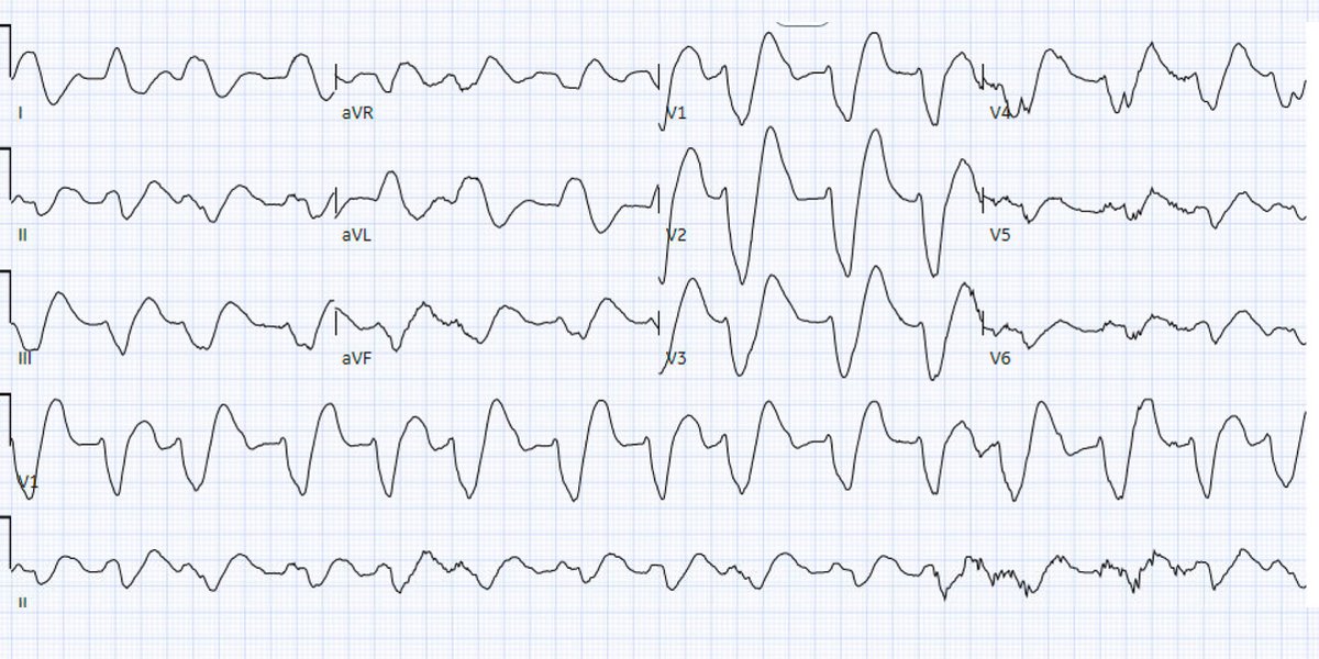 Academic Life in EM (@aliemteam) on Twitter photo ACMT Toxicology Visual Pearl: Salt, not Shock - By Drs. Harmon, Sidlak, and Singletary
What agent would most likely be responsible for these ECG findings?
*Cyclobenzaprine
*Digoxin
*Flecainide
*Sotalol
Read more: aliem.com/acmt-salt-not-…
<a href="/acmtmedtox/">American College of Medical Toxicology</a> ACMT Toxicology Visual Pearl: Salt, not Shock - By Drs. Harmon, Sidlak, and Singletary
What agent would most likely be responsible for these ECG findings?
*Cyclobenzaprine
*Digoxin
*Flecainide
*Sotalol
Read more: aliem.com/acmt-salt-not-…
<a href="/acmtmedtox/">American College of Medical Toxicology</a>