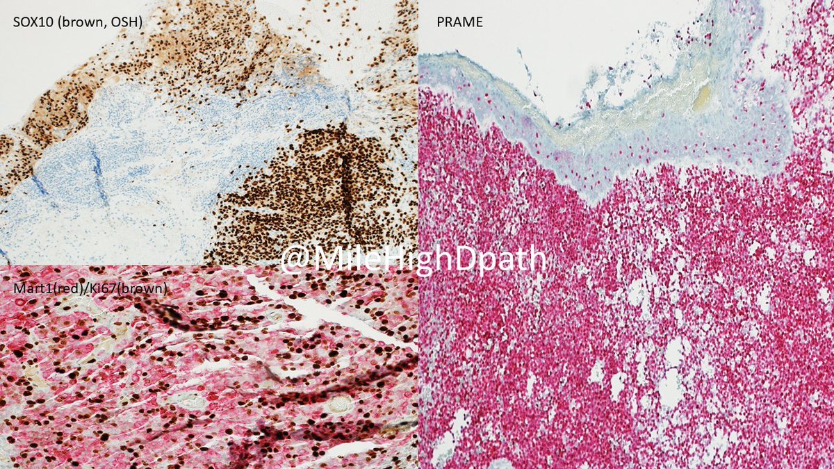MileHighDpath's tweet photo. Young man (<30 y/o).  Noted lesion for several years.  Dx as pyogenic granuloma at some point, but continued to grow.  Bx performed. 

The best dx is:
A) cavernous hemangioma
B) Kaposi sarcoma
C) melanoma
D) pyogenic granuloma

#Dermquiz, #Dermpathquiz, #ConjunctivalLesion https://t.co/D1y3aFFM3y
