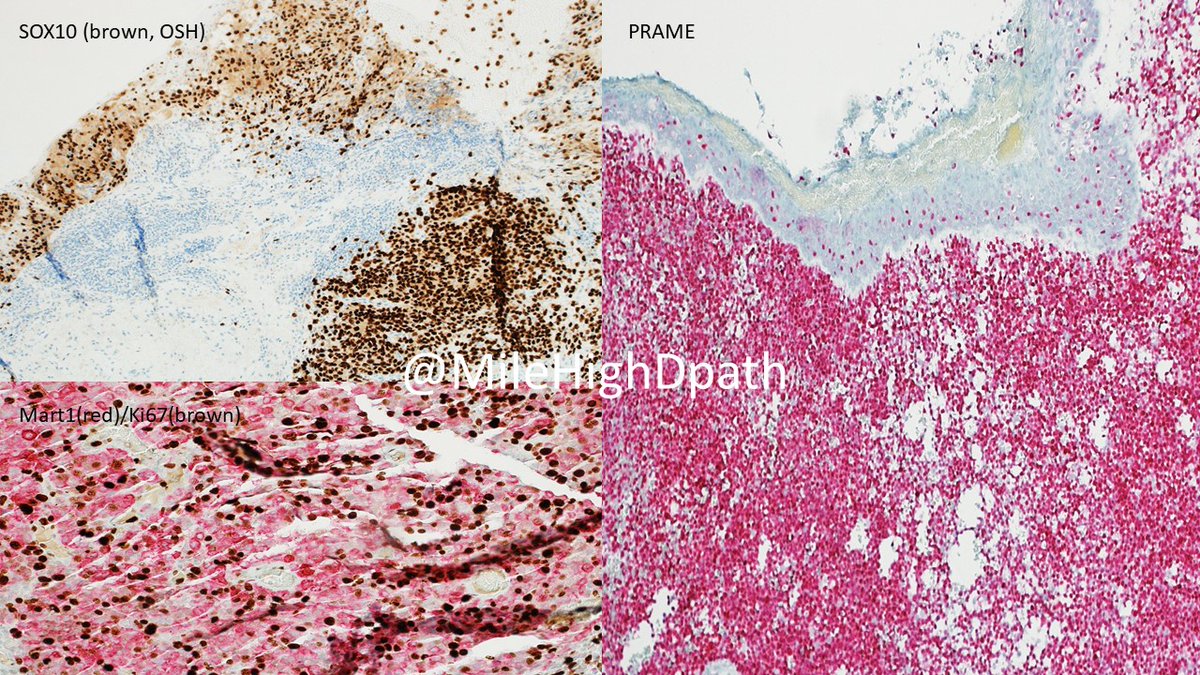 Young man (<30 y/o). Noted lesion for several years. Dx as pyogenic granuloma at some point, but continued to grow. Bx performed. The best dx is: A) cavernous hemangioma B) Kaposi sarcoma C) melanoma D) pyogenic granuloma #Dermquiz, #Dermpathquiz, #ConjunctivalLesion