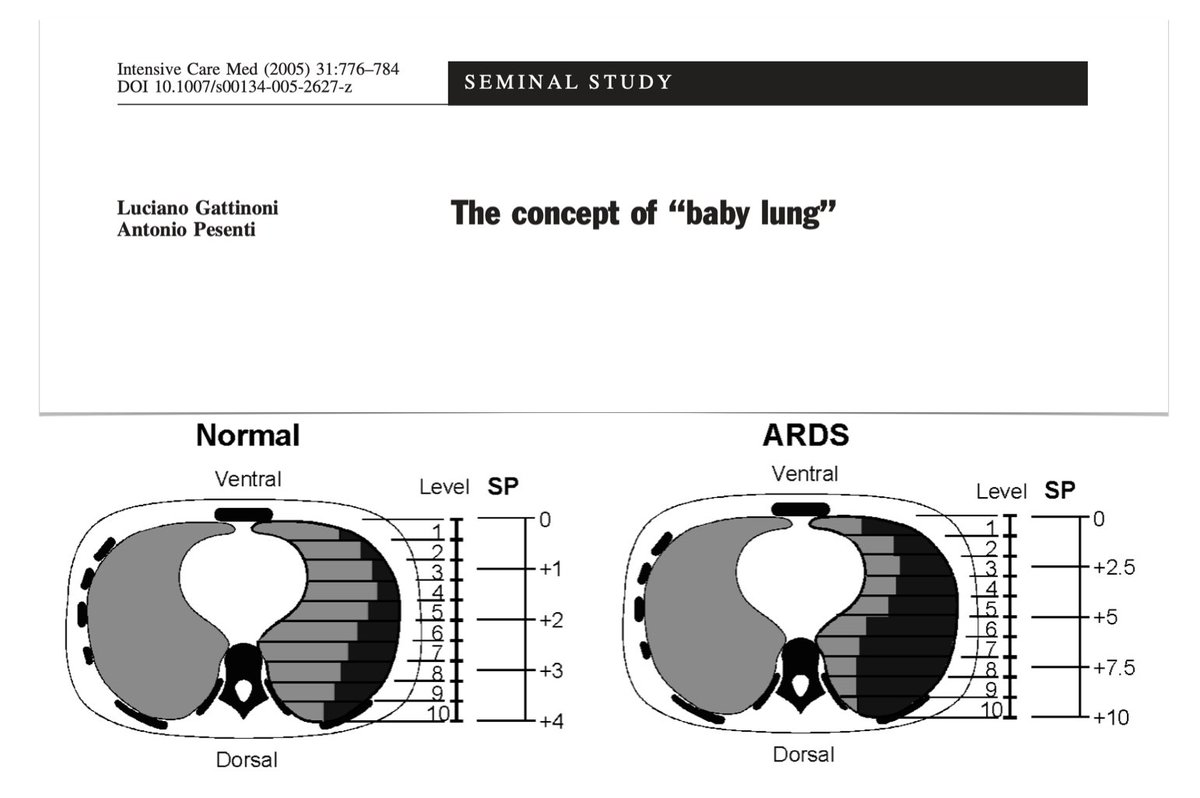 🗃️From @yourICM archives... The concept of baby lung 🫁 from 1970s to middle 1980s 🍼 🫁middle 1980s: baby lung concept 🧽 from baby to sponge lung 🫁 baby lung at end-inspiration 🥅 protective lung strategy: changing goals ⚠️ VILI #FOAMcc #ICMilestones 🔓rdcu.be/dyyCj