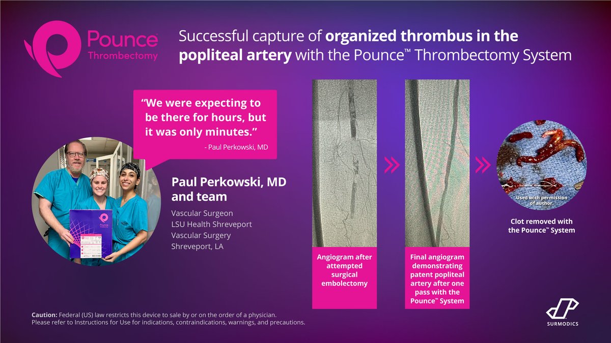Dr. Paul Perkowski and team @OchsnerHealth were able to successfully capture organized #thrombus in the popliteal artery in just minutes with the Pounce™ #Thrombectomy System after an attempted surgical embolectomy. Join the hunt at hubs.ly/Q02kXY2N0 #meddevice Rx only.