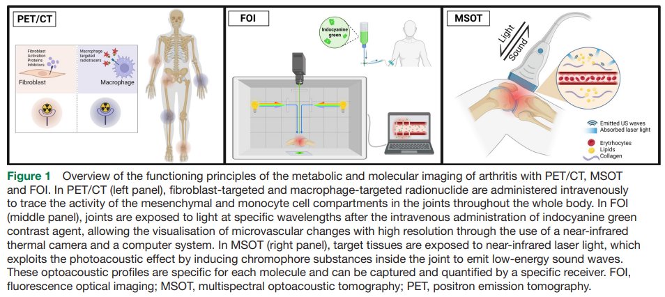 eular_ARD's tweet photo. 🔡 All you wanted to know about metabolic and molecular #imaging in #inflammatoryarthritis is in this Review❗ 

Visualising &amp; measuring metabolic tissue activity useful to identify #biomarkers of #diseaseactivity in a very early phase

🔗 https://t.co/qO3OH6DlVx

@KorayTascilar https://t.co/fTSb5VVbA2