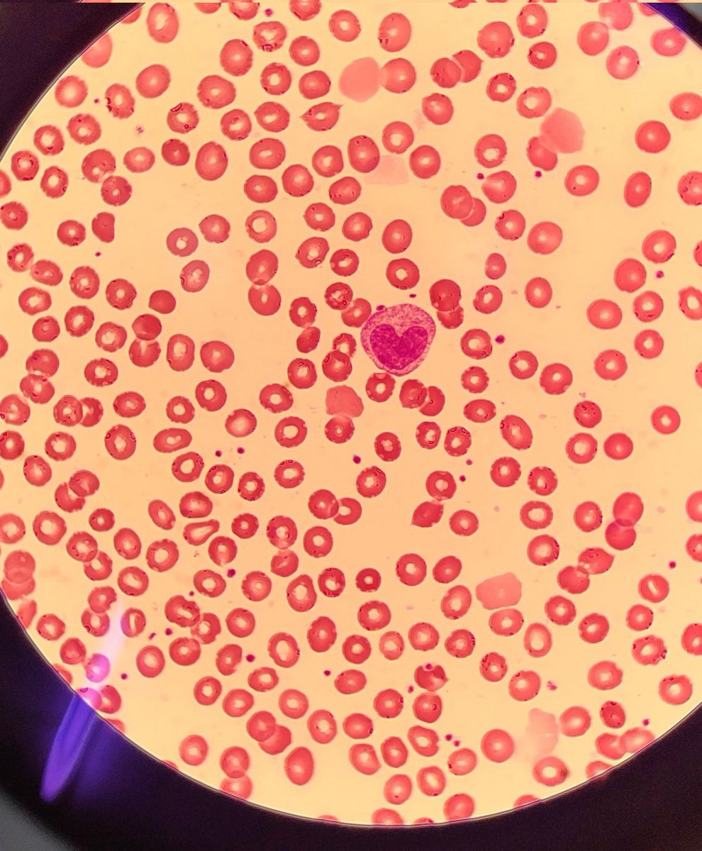 drkeithsiau's tweet photo. A lovely finding on blood film. What’s the diagnosis? https://t.co/szYqmaHFpp