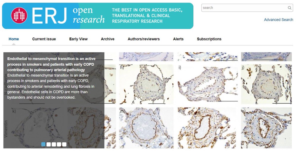 Sukhwinder Singh Sohal 🫁 (@romy_sohal) on Twitter photo Delighted to see our recent EndMT work in smokers, patients with small #airway disease and early #COPD highlighted on ERJ Open’s front page. Thanks very much <a href="/ERSpublications/">ERS publications</a> 🤗 @bhprem86 <a href="/Monica_w_LU/">Monica (Wenying) Lu</a> <a href="/matsuji2013/">Mathew Suji Eapen</a> <a href="/deys79/">Surajit Dey</a> <a href="/AffanShahzad7/">Affan Shahzad</a> <a href="/Archana_AUS/">Archana Gaikwad</a> bit.ly/49TtZBZ Delighted to see our recent EndMT work in smokers, patients with small #airway disease and early #COPD highlighted on ERJ Open’s front page. Thanks very much <a href="/ERSpublications/">ERS publications</a> 🤗 @bhprem86 <a href="/Monica_w_LU/">Monica (Wenying) Lu</a> <a href="/matsuji2013/">Mathew Suji Eapen</a> <a href="/deys79/">Surajit Dey</a> <a href="/AffanShahzad7/">Affan Shahzad</a> <a href="/Archana_AUS/">Archana Gaikwad</a> bit.ly/49TtZBZ