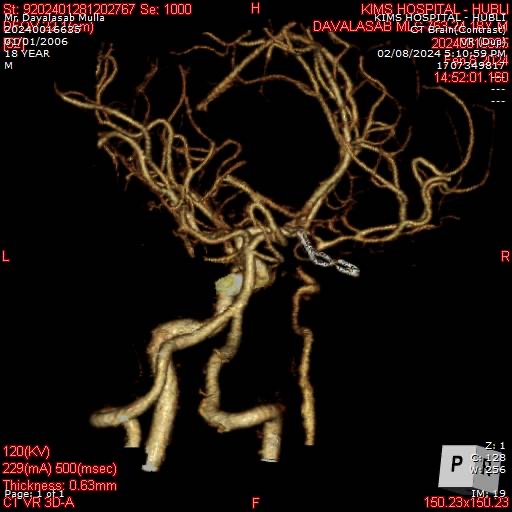<a href="/KIMSHubballi/">KMCRI ( Formerly KMC/KIMS) HUBBALLI</a> Management of Right ICA aneurysm. 
#aneurysm #aneurysmmanagement #aneurysmclipping