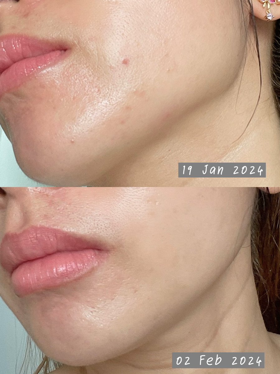 AoffyMyname's tweet image. เซรั่ม SOS ตัวใหม่จากบ้าน Eucerin เหลือร้ายนะ กับเราเห็นผลเรื่องลดสิวอุดตัน ตอนใช้แรกๆ เหมือนจะดันสิวแต่ไม่เยอะ สังเกตุอีกทีสิวที่เหมือนจะปะทุก็ยุบไปเอง active ตัวฆ่าเชื้อสิวเค้าดีจริง ไม่งั้นที่เห็นตุ่มๆ อักเสบไปแล้ว เอาไว้ทา maintain ช่วยลดสิวซ้ำซากได้ด้วย #Eucerinthailand…