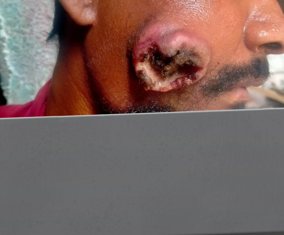 kausar_nargis's tweet photo. Young Labourer, only earning member of family
having a 5yro son, wife & widow mother
He is under evaluation of mouth #Cancer
Kindly #Donate for #Catastrophic charges & for CECT (skull base to clavicle) & CECT chest
Treatment will be under govt fascilities
#Target_25k
#RT https://t.co/awpvRT9qq4