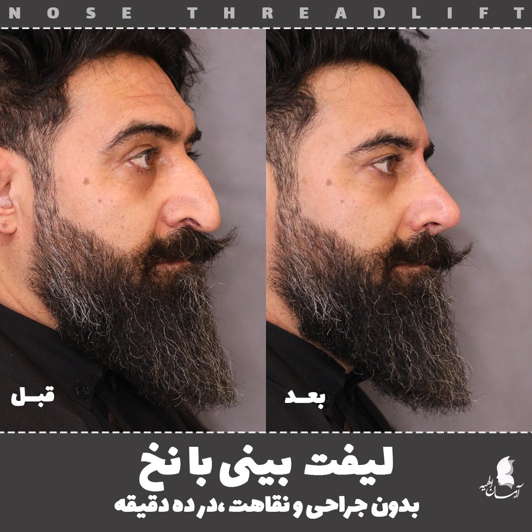 Arman_elahie's tweet image. با نخ هم می توان سر بینی را بالا کشید و هم پوست را جلو کشید و رفع قوز کرد. ولی اگر فردی بینی فانتزی و سربالا می خواهد بهتر است جراحی کند که دکتر خواجه رحیمی فوق تخصص جراحی پلاستیک در کلینیک ما حضور دارند.
#لیفت_بینی #لیفت_بینی_با_نخ #nosethreadlift #noselift