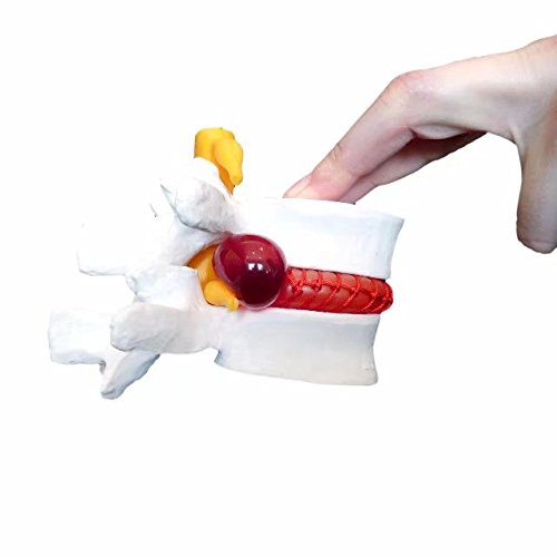 alvarogfisio's tweet photo. Este modelo es conocido por todos para describir cómo funciona una hernia lumbar, de este entendemos que la flexión agrava la hernia y la extensión la “reabsorbe”.

Veamos que hay de cierto en ello (spoiler: Poco)
🧵 https://t.co/40GZ0ESGIl