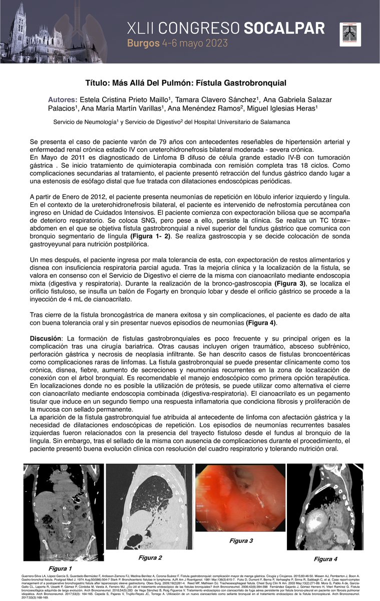 📑 #CasoClínico: 'Más allá del pulmón: Fístula Gastrobronquial' Servicio de #Neumología y Servicio de #Digestivo del Hospital Universitario de #Salamanca.