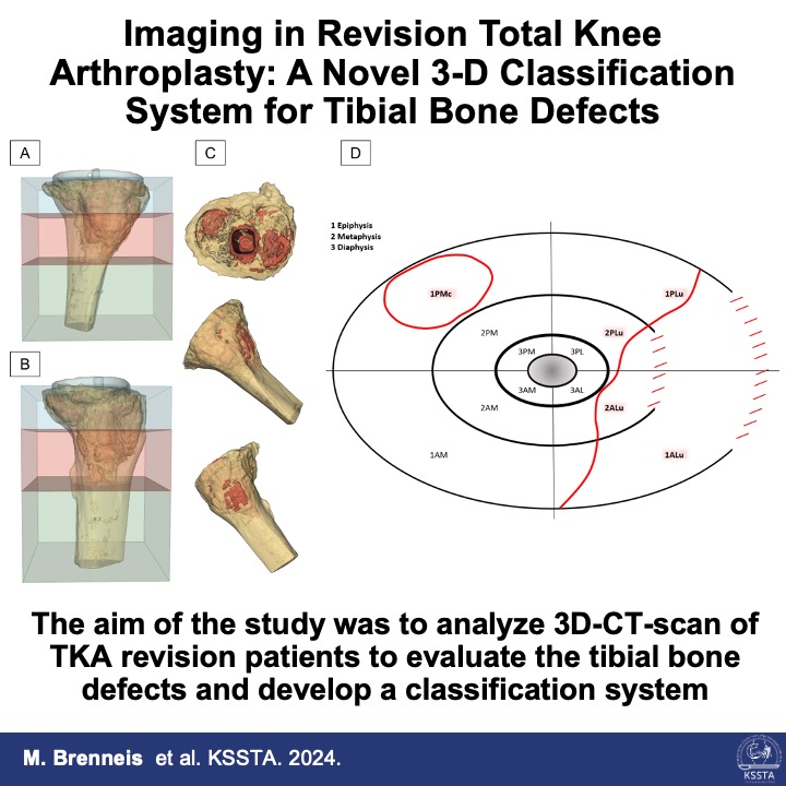 KSSTA's tweet photo. A new classification of bone defects on a 3D-CT scan can help you evaluate the tibial defect and plan for augment/cones before surgery!
#knee #revision #totalknee #bonedefects #orthopaedics #arthroplasty #TKA
Find out more here: https://t.co/4dd1PkEHhC https://t.co/9pMXaMZNAl