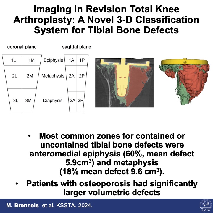 KSSTA's tweet photo. A new classification of bone defects on a 3D-CT scan can help you evaluate the tibial defect and plan for augment/cones before surgery!
#knee #revision #totalknee #bonedefects #orthopaedics #arthroplasty #TKA
Find out more here: https://t.co/4dd1PkEHhC https://t.co/9pMXaMZNAl