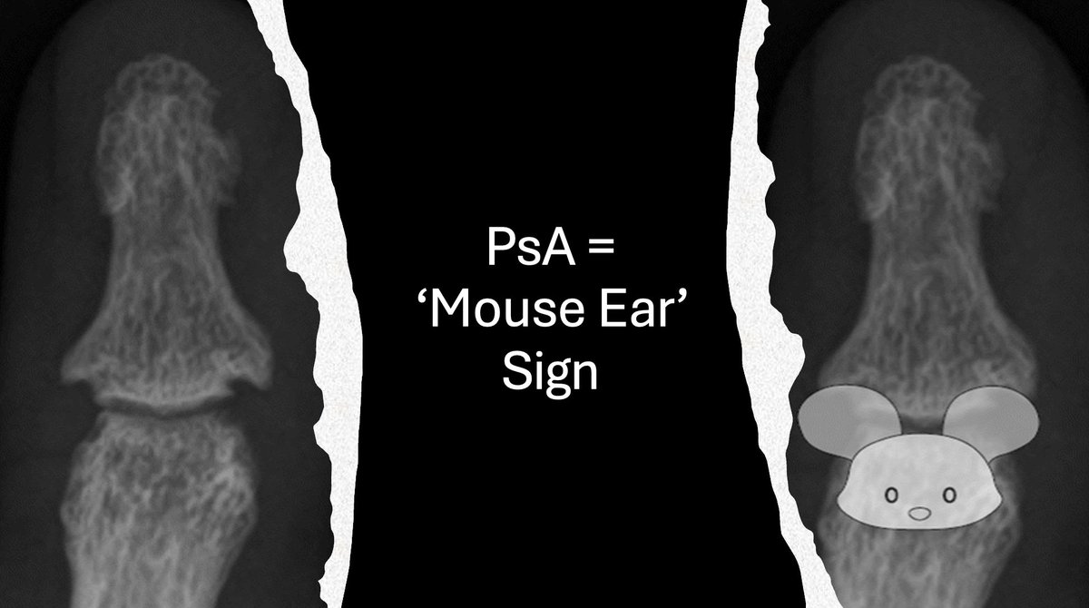 Psoriatic arthritis or Erosive Inflammatory OA?
Can be very tricky Hx & Ex impt but sometimes still unclear! 
#PsA = ‘Mouse Ear’ sign & marginal erosions. 
Enthesitis, Dactylitis
#OA = Erosions central ‘Gull Wing’ w/outer lip of reactive bone (Serology N)
Doesn’t respond to Rx!