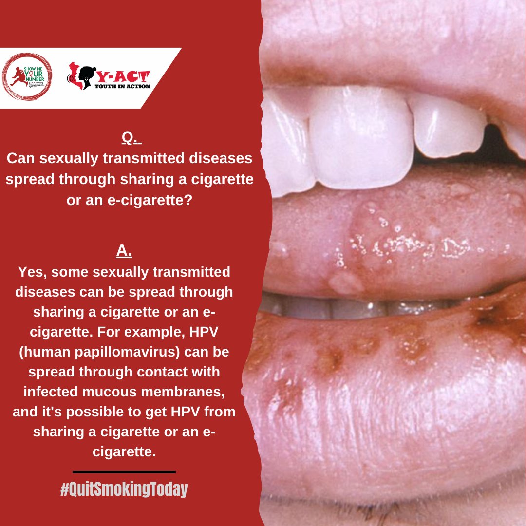 Some STDs can spread through sharing a cigarette. #NoToSmoking #QuitSmoking #SMYN @Amref_Worldwide @WHO @YACT_Africa @HealthZA