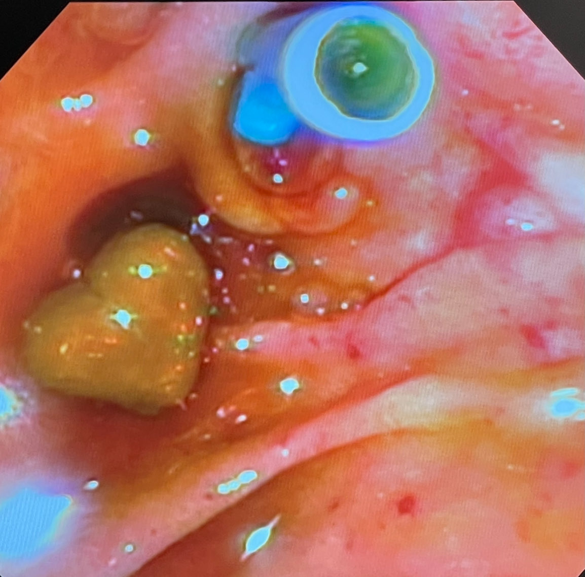 Happy Valentine’s Day through the lens of biliary endoscopy!