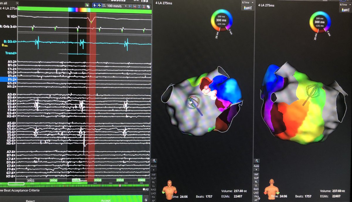 EduFrancoDiez's tweet photo. Atypical AFL! Small reentry near LAA base (1st image) in 👴🏻 with prior PVI + anterior mitral line + CS ostium focal ablation. Due to prior ablation set, AFL was confined within the lateral LA, whereas 2:1 conduction to the septal aspect of the LA and RA was noted (2nd image) 🤩 https://t.co/8yCoM3QNdU