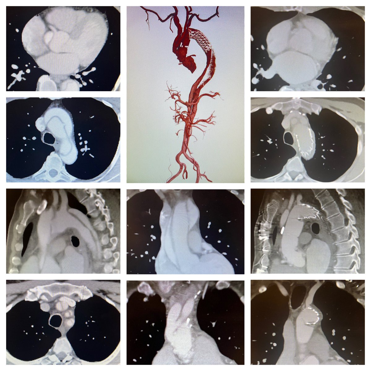 Kim de la Cruz, MD MPH(c) FACS FACC FCCP tweet media