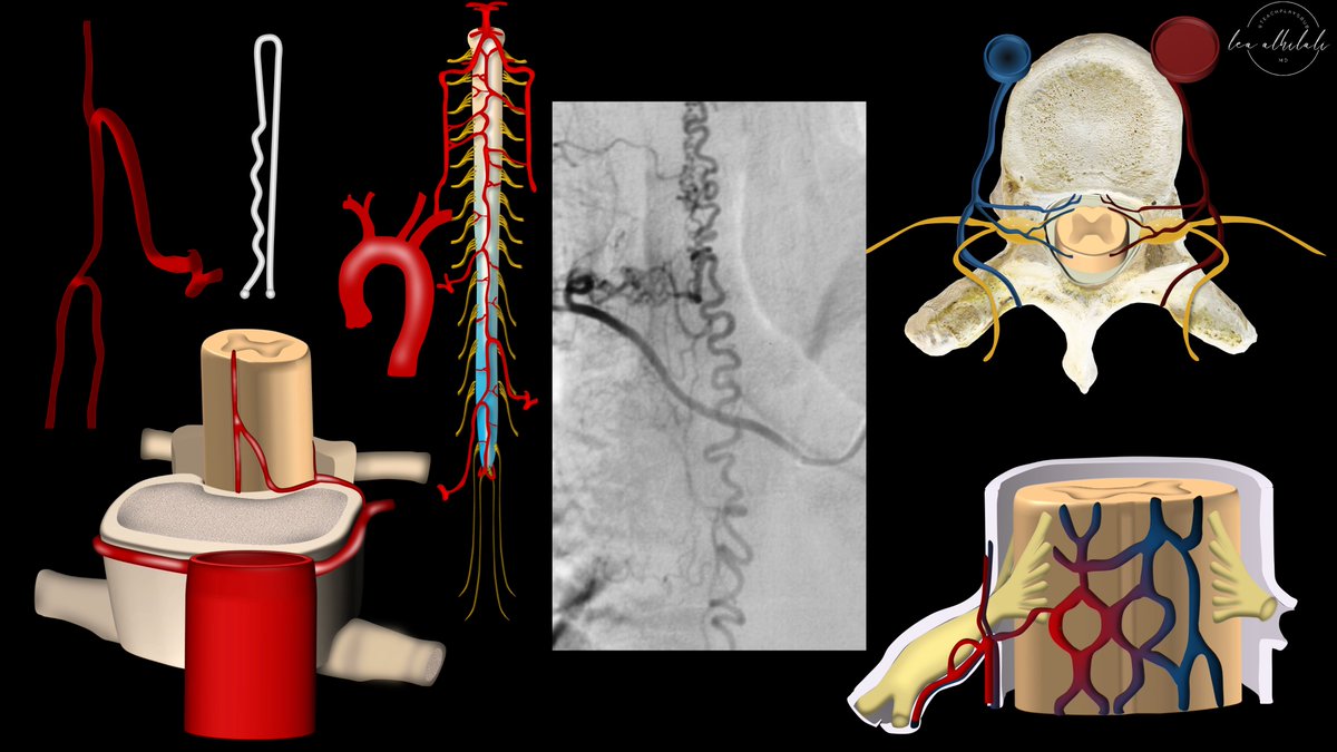 1/Talk about twisting your back! Do spine vascular lesions make your brain feel as tangled as the dilated vessels you see? Want some information on malformations? Here’s a thread on spine vascular anatomy to give you durable knowledge on dural arteriovenous fistulas (dAVF)