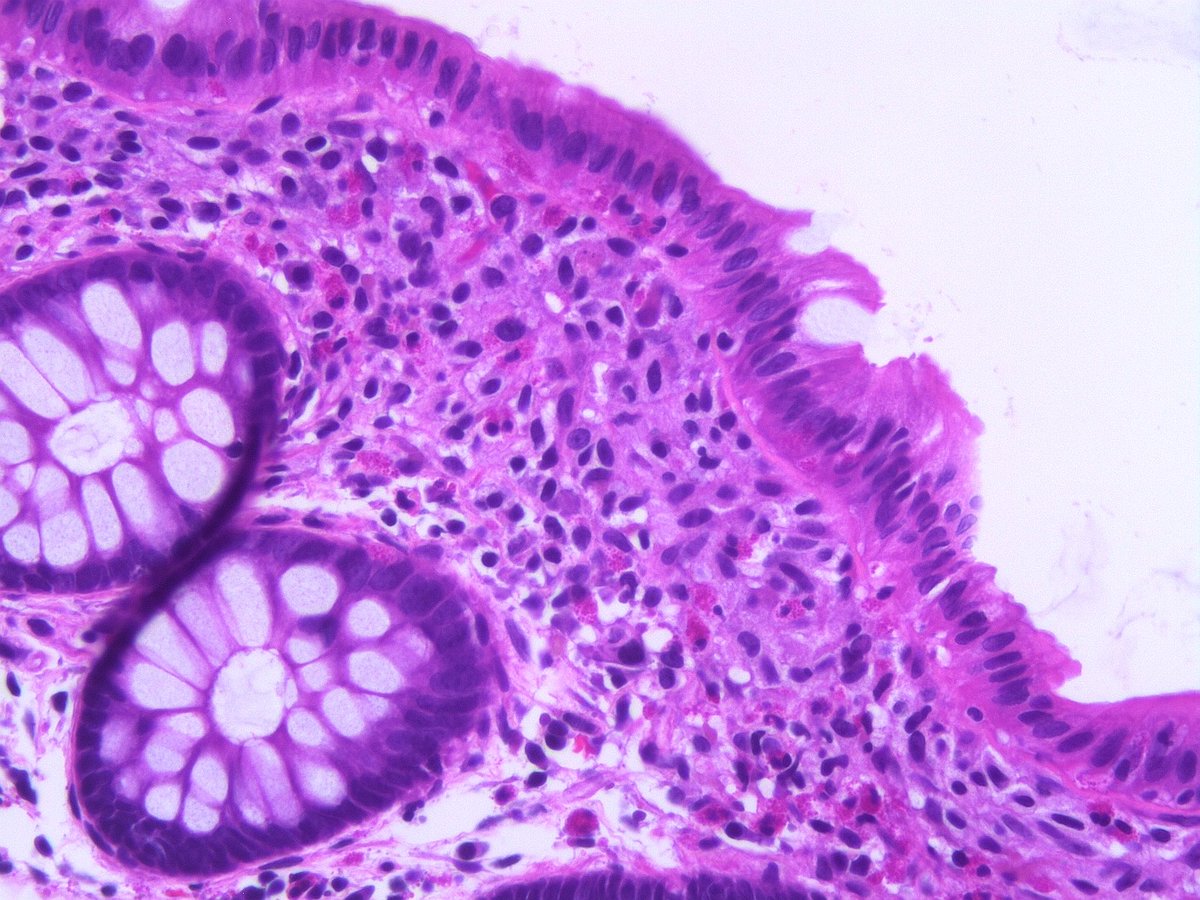 Interesting Colon Biopsy. What do you think? #gipath #pathology