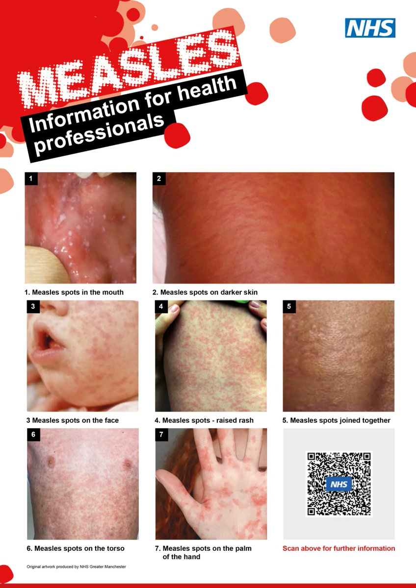 CentrePadiham's tweet photo. Measles cases are on the rise again around the UK.  Please contact the practice at the earliest opportunity if you display any of the symptoms https://t.co/hp8oFrZI1e