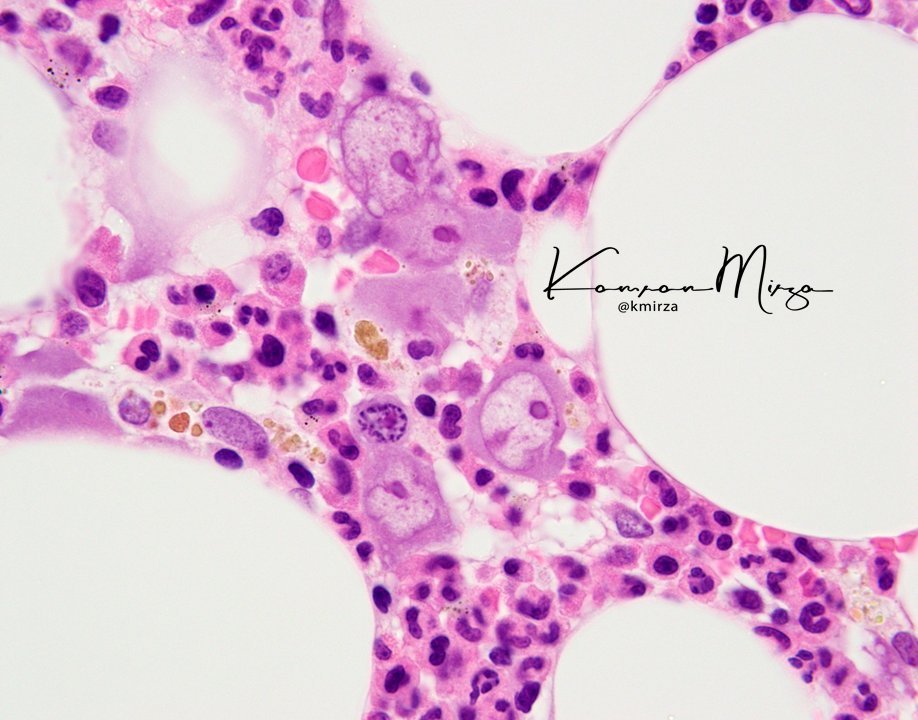 Happy #humpdayHemepath y'all! Kid with anemia - what's the finding in this bone marrow? @UMichPath @umichmedicine @UMichMedSchool @UMich @nihardesai7 @ASH_hematology @HemOncFellows 🏮