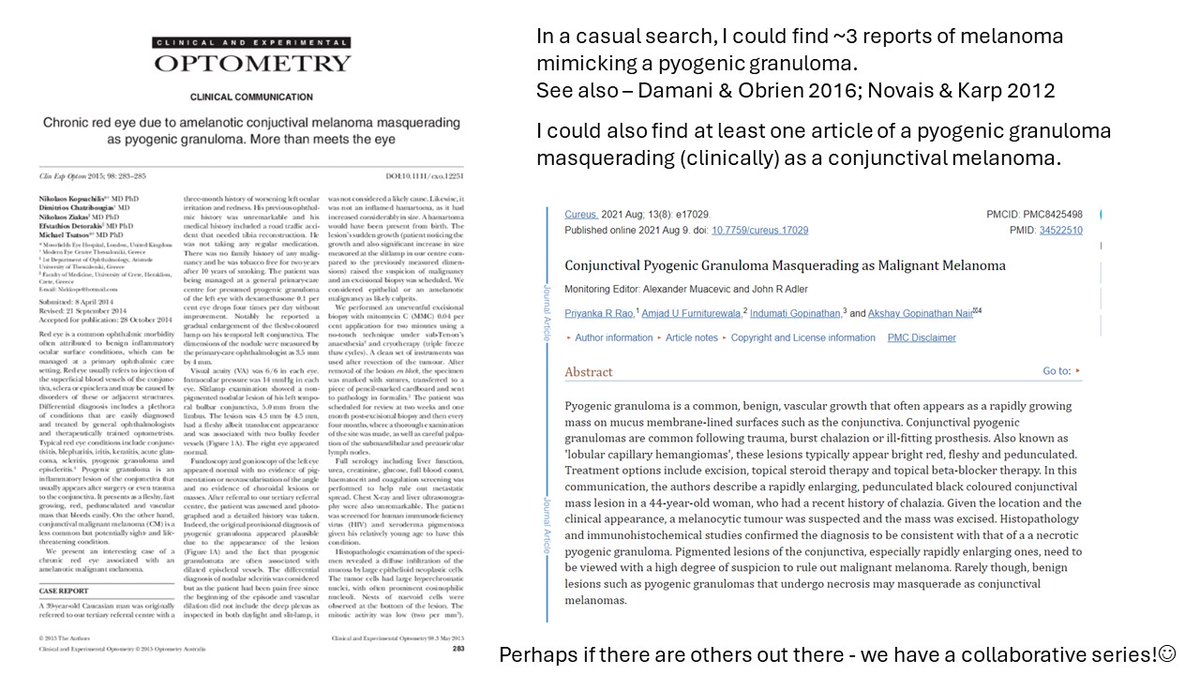 MileHighDpath's tweet photo. My answers:
TRUE -pT criteria differ for conjunct MM, some in dermpaths own group unaware;
TRUE -subjectivity here, no fighting, but IMHO the utility is about same;
TRUE -reports of conjunctival MM confused with PG and vice/versa
Refs attached.
Hope that expands ur knowledge!🙂 https://t.co/wdwDK6uOr4