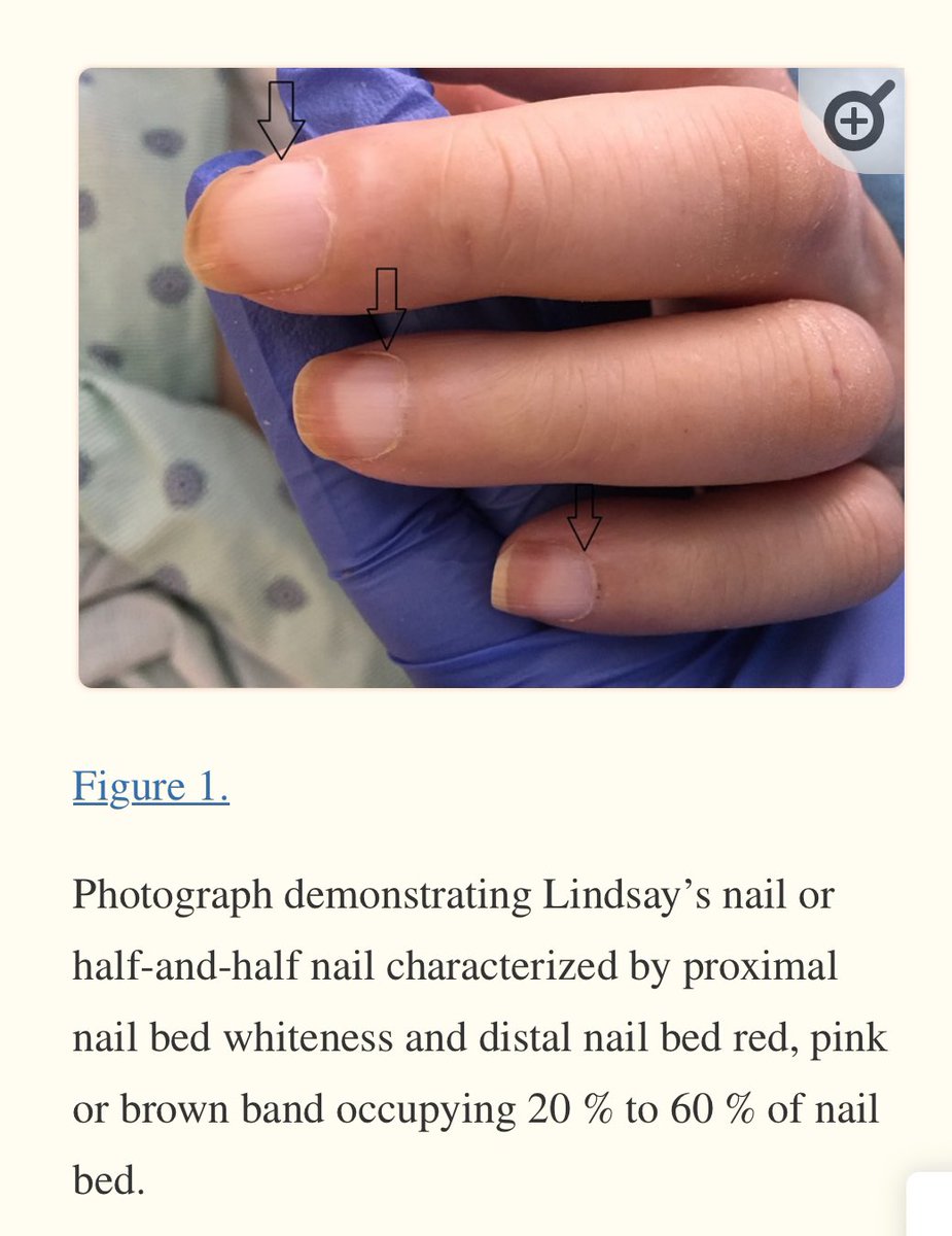 PDF) Chronic kidney disease entertained from Lindsay's nails: A case report  and literature review