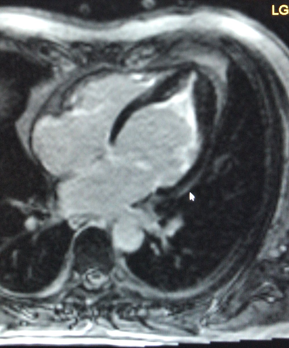 GrublerMartin's tweet photo. Nice case of EMF. Pt was referred for apical HCM. Caucasian male, 33y/o, no sign PMHx, no hypereosinophilia. Genetics show likely pathogenic PKP2 variant ❤️🩹 #CMR #cmrfirst #FOAMed #eacvi #whycmr #yescct https://t.co/dquQSnMVv9