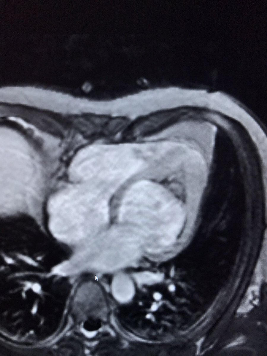 GrublerMartin's tweet photo. Nice case of EMF. Pt was referred for apical HCM. Caucasian male, 33y/o, no sign PMHx, no hypereosinophilia. Genetics show likely pathogenic PKP2 variant ❤️🩹 #CMR #cmrfirst #FOAMed #eacvi #whycmr #yescct https://t.co/dquQSnMVv9