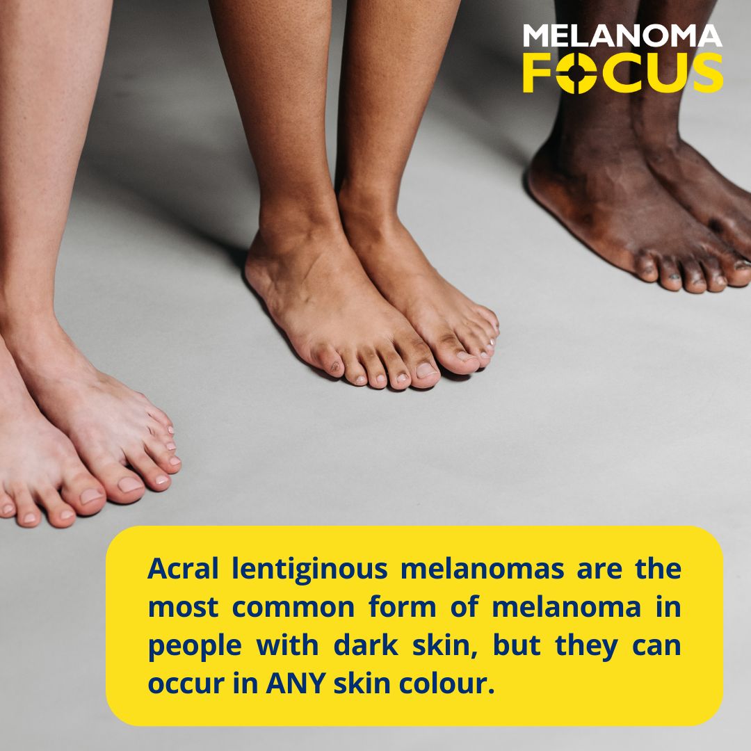 There is a common misconception that melanoma skin cancer doesn’t occur in people with black or darker skin tones. Acral Lentiginous melanomas are the most common form of melanoma in people with dark skin. But they can occur in ANY skin colour. Info: buff.ly/3VQsJZr