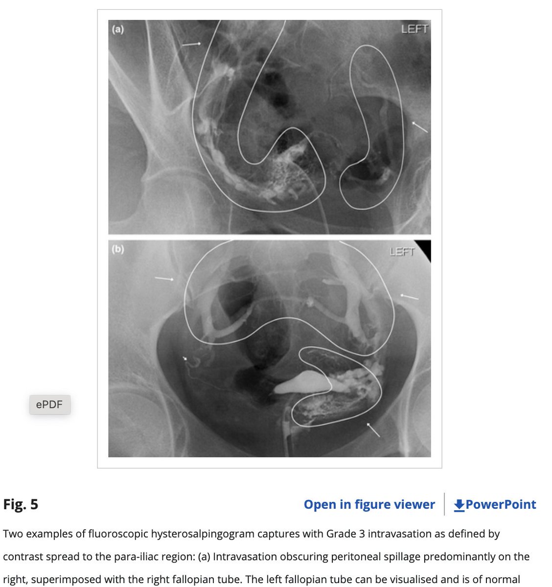 An example of Grade 3 intravasation on HSG, where contrast has spread to the para-iliac region. By @EmmelineLee and @ciyuechia