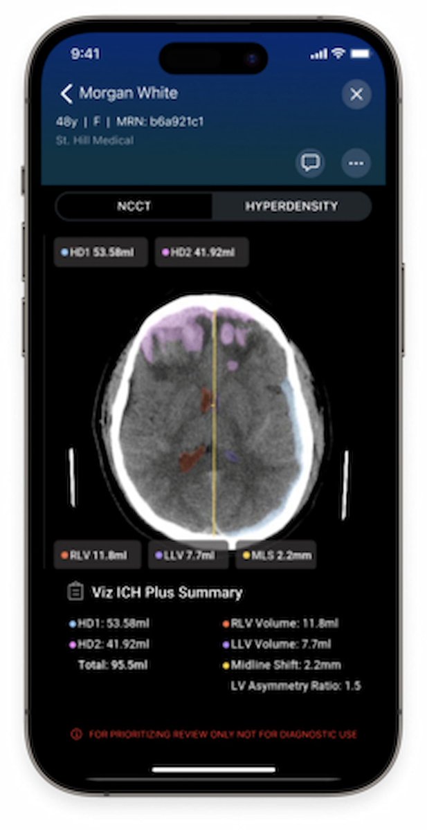 FDA Clears #AI Software for Assessing Intracerebral Hemorrhage on Non-Contrast CT diagnosticimaging.com/view/fda-ai-so… <a href="/ACRRFS/">ACR RFS - We've Moved! Follow <a href="/RadiologyACR/">American College of Radiology</a>.</a> <a href="/ACRYPS/">ACR YPS- We've Moved! Follow @RadiologyACR.</a> @RadiologyACR <a href="/ARRS_Radiology/">ARRS</a> <a href="/TheASNR/">The American Society of Neuroradiology</a> <a href="/DukeRadiology/">Duke Radiology</a> <a href="/NURadiology/">Northwestern Radiology</a> <a href="/JeffersonRads/">Jefferson Radiology</a> <a href="/UABRadiology/">UAB Radiology</a> <a href="/UMichRadiology/">Michigan Radiology</a> <a href="/TulaneRadiology/">Tulane Radiology</a> <a href="/viz_ai/">Viz.ai</a> #radiology #RadRes