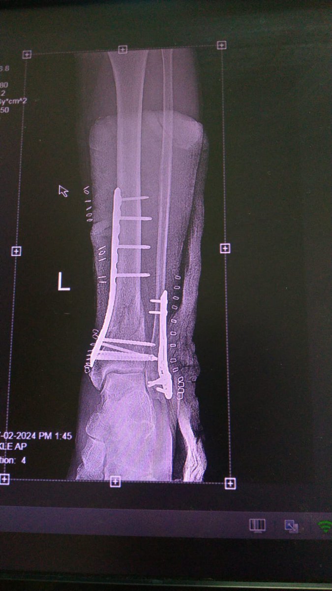 ORTHODOC1234's tweet photo. Tibia pilon fracture ..AO C3 type
Orif of fibula first 
Mippo of distal tibia.
@InvictaOrtho @OrthoTwiter https://t.co/MUQGR3N5xH