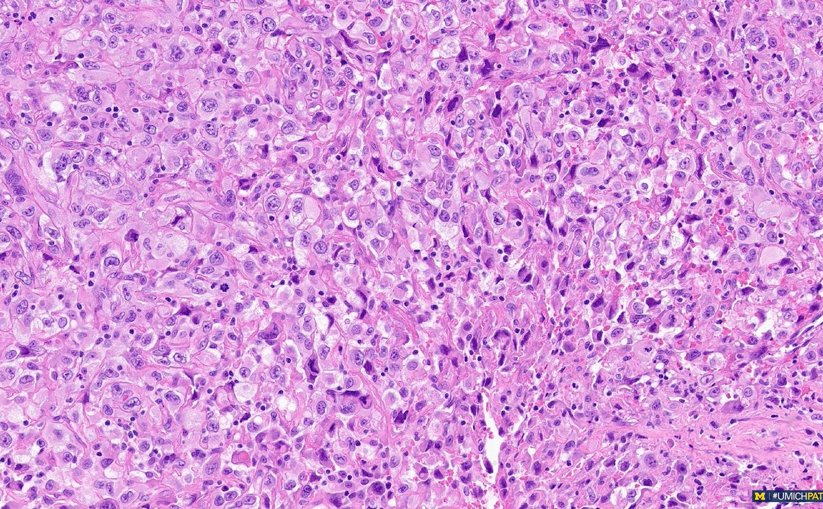 Michigan Pathology (@umichpath) on Twitter photo 🔬Check out the new #COTW from <a href="/sarahnfarran/">Sarah Farran, MD, MPH</a>!
An 84-year-old female presents with productive cough, is found to have a loculated pleural effusion on CT scan. Pleural biopsy shows the following. What is your diagnosis? Which molecular correlates support the diagnosis? 🔬Check out the new #COTW from <a href="/sarahnfarran/">Sarah Farran, MD, MPH</a>!
An 84-year-old female presents with productive cough, is found to have a loculated pleural effusion on CT scan. Pleural biopsy shows the following. What is your diagnosis? Which molecular correlates support the diagnosis?