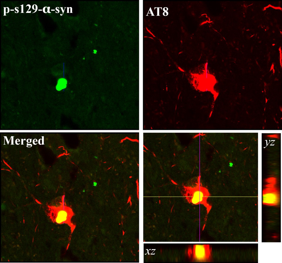 By comparing the brains of pts with mild motor deficits ± nigral synucleinopathy vs. sporadic PD, Chu et al. provide evidence that initiation of nigrostriatal DAergic degeneration occurs independently of a-syn aggregation and can be tau mediated. tinyurl.com/yn3aanun