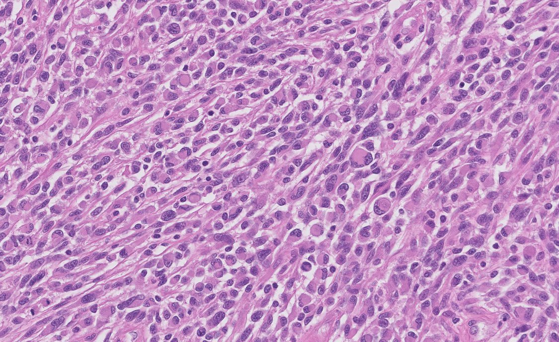 PeterKobalka's tweet image. Yes, this is met epithelioid GBM!  Below, original resection, GFAP, olig-2, then one of the LN Mets #neuropathology #cnspath #neuropath