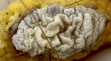 vintage81106614's tweet image. The art of grossing. A 64 yo woman presented with a 2.4x1cm raised plaque in the skin of the rigth breast. Final DX. Squamous Cell Carcinoma In Situ (no further lesions were found). #pathology #pathres #pathTwitter