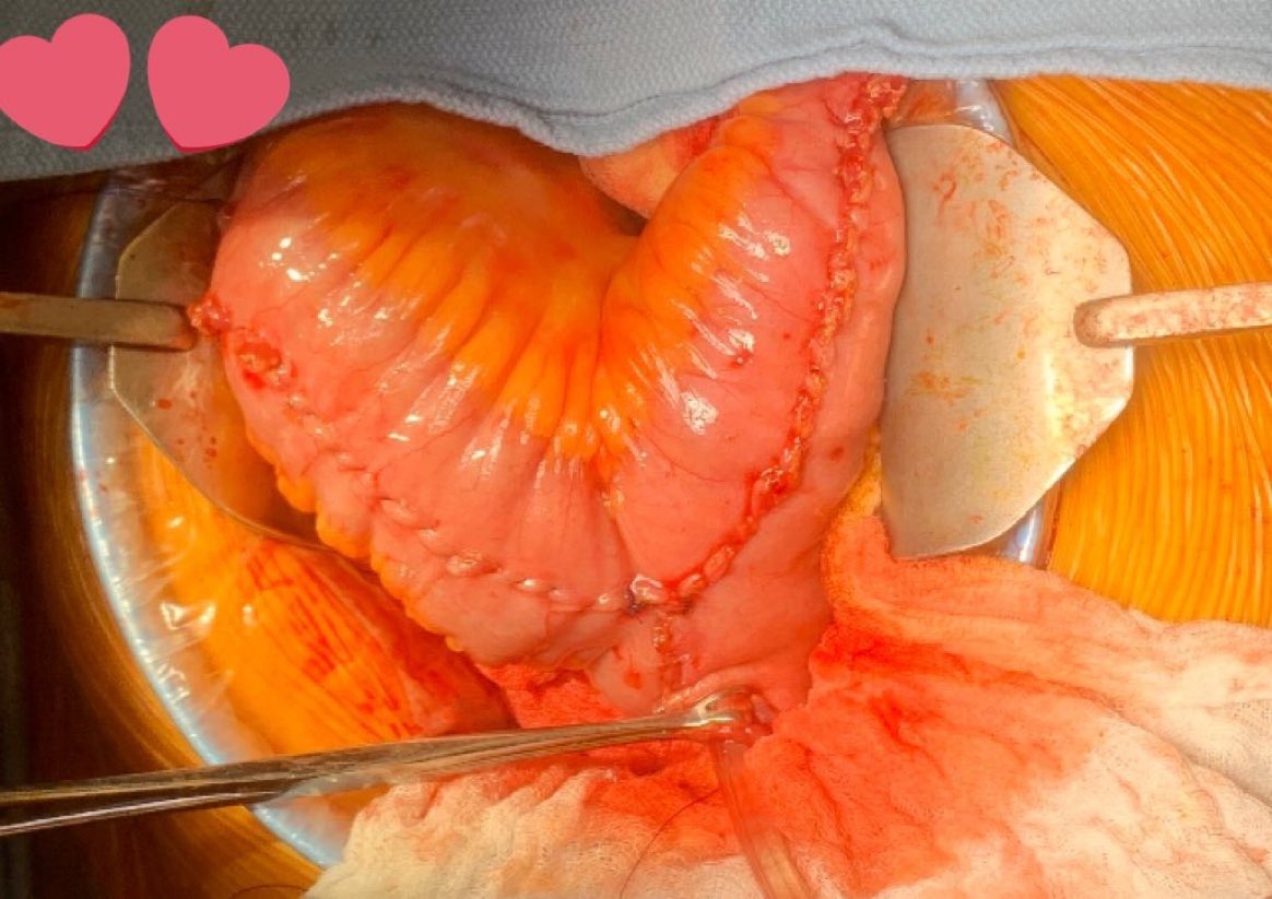 Laura Bukavina (@laurabukavinamd) on Twitter photo Roses 🌹 are red
Violets are blue
Here is a little neobladder 💕 LOVE for U
<a href="/AdamCalaway/">Adam Calaway</a> 📸 Roses 🌹 are red
Violets are blue
Here is a little neobladder 💕 LOVE for U
<a href="/AdamCalaway/">Adam Calaway</a> 📸