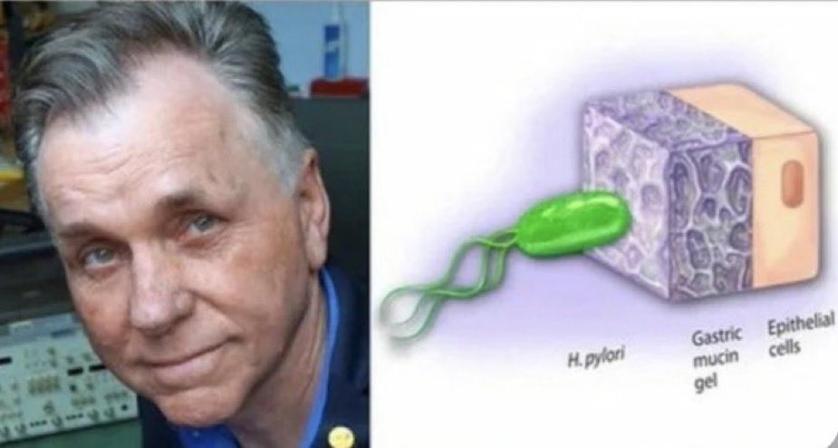 Barry Marshall was convinced that the Helicobacter pylori bacteria caused stomach ulcers, but no one believed him. Since it was illegal to test his theory on humans, he drank the bacteria himself and developed ulcers within days. He treated them with antibiotics and we on to